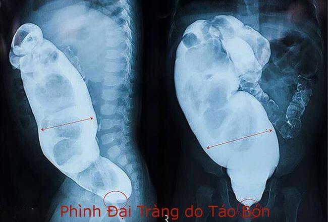 táo bón nguy hiểm như thế nào